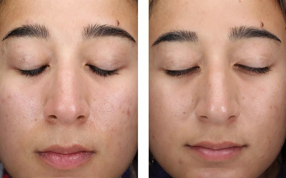 AlphaRet Clearing Serum