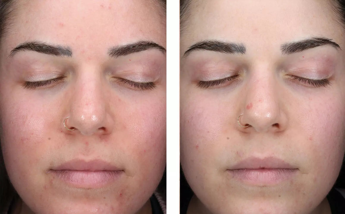 AlphaRet Clearing Serum