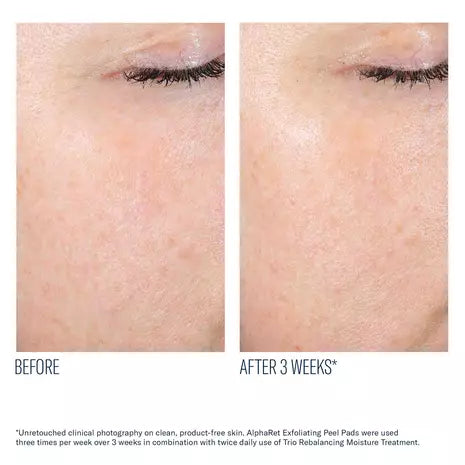 AlphaRet Exfoliating Peel Pads